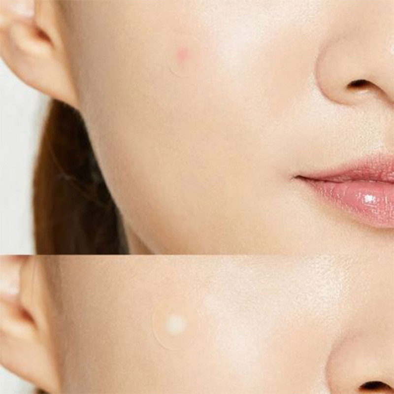 چسب ضد جوش پنرول مدل PRD Acne Cover Patch 360 بسته 36 عددی