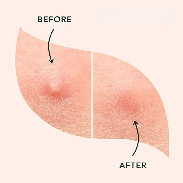 چسب ضد جوش پنرول مدل PRD Acne Cover Patch 360 بسته 36 عددی